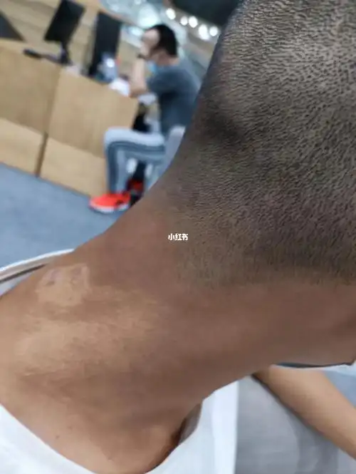 干癣,表面是干的,脱屑,皮肤底下是湿的,湿在肌肉.