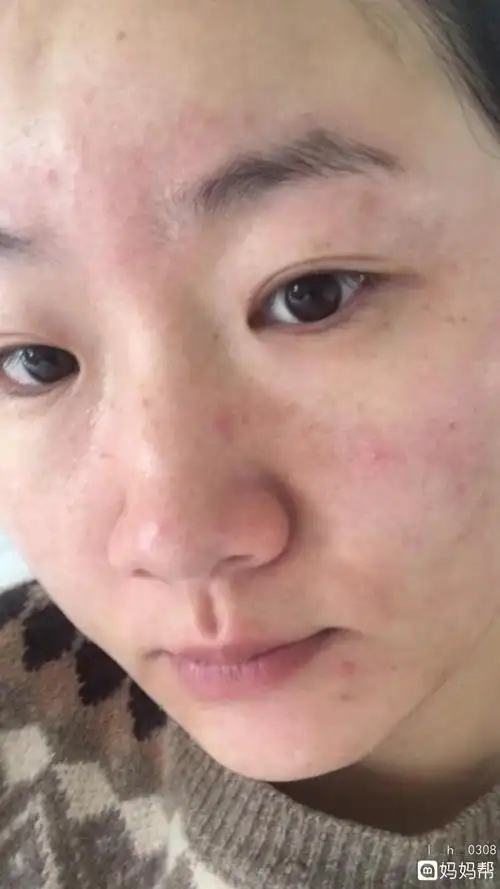 如何去脸上晒斑(如何去除脸上晒斑)