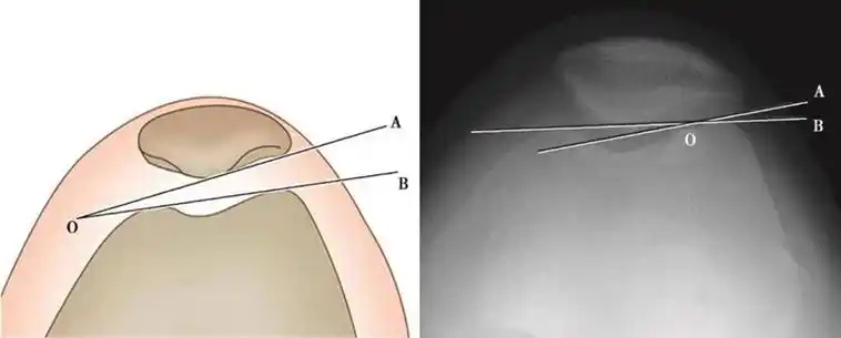 髌股关节轴位影像学表现
