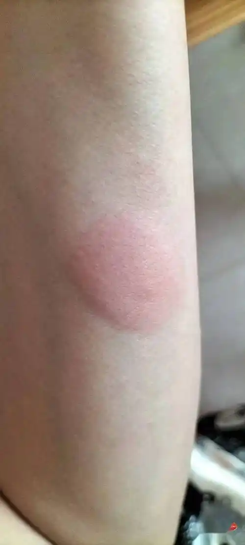 去钦州三墩游玩要小心红色的蚂蚁!