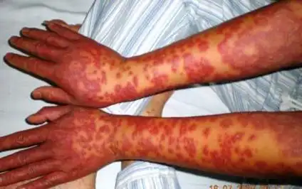 多形红斑的临床表现有哪些?