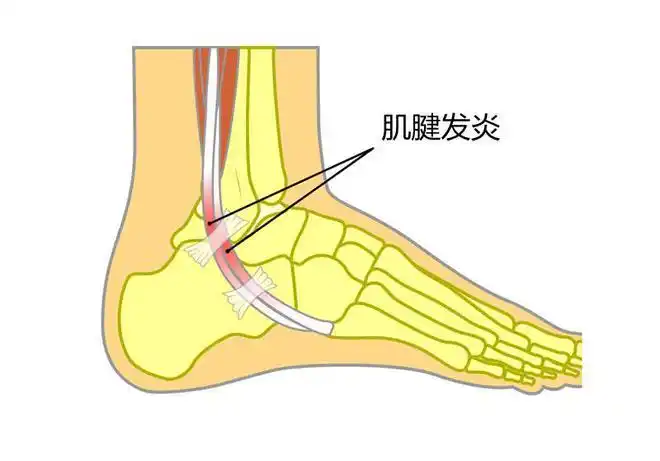 出现脚踝以及小腿外侧疼痛,就可能是腓骨肌腱炎,它是长时间过度活动