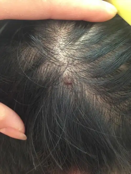 头上长了个疙瘩,不痛不痒,我20岁,好像慢慢变硬了,严重吗?