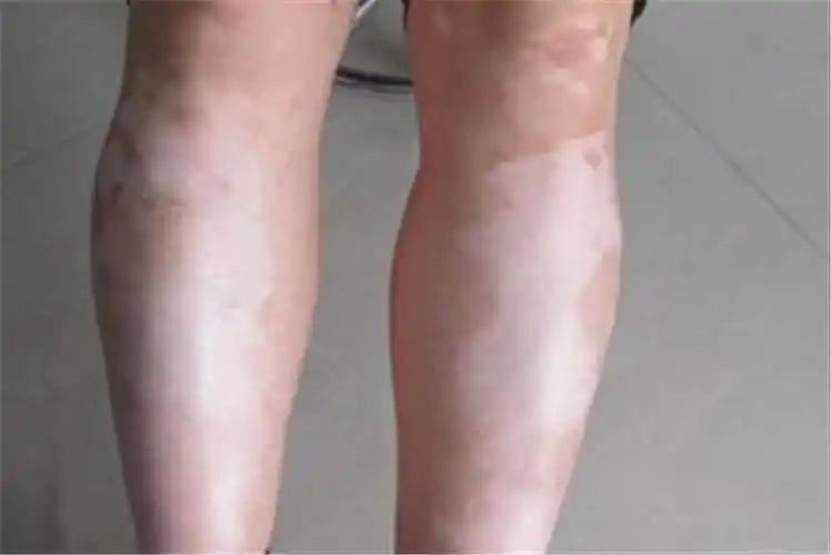 眼角白癜风早期症状图片