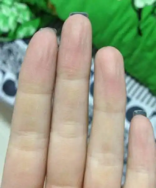 气血亏的手指肚