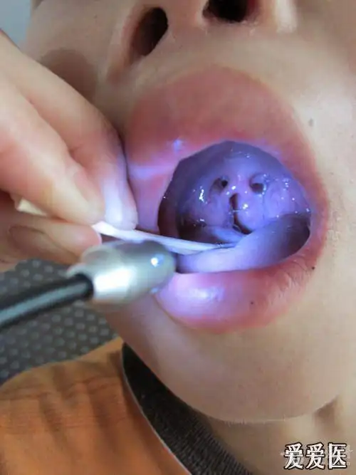 悬雍垂分裂如何判断做不做手术