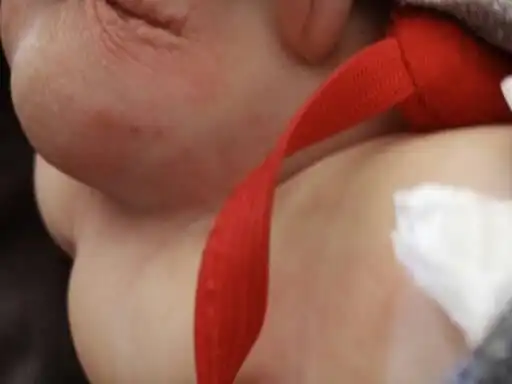 请问我儿子这红点点是什么呀?是尿不湿捂的吗?只有一边有