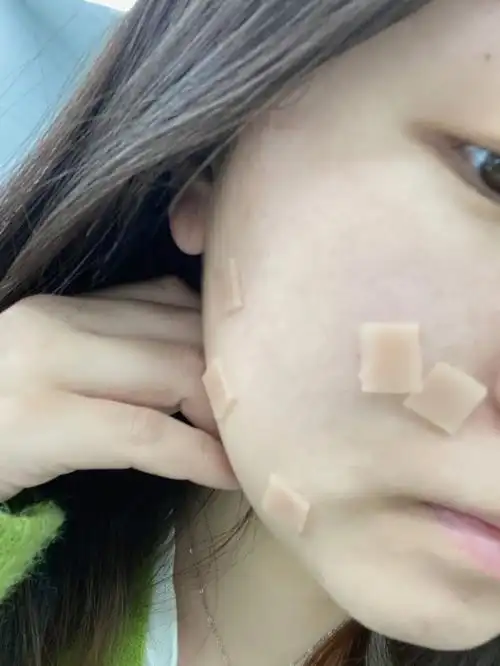 点痣笔记点完到恢复用时仨月已成功上岸