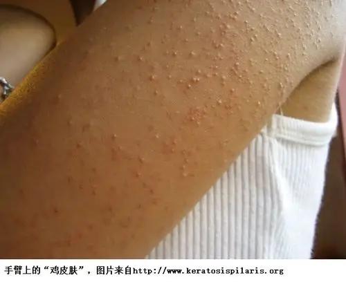 它是一种无法根治的常染色体遗传性皮肤疾病,俗称鸡皮病,学名:毛囊