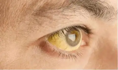 十年乙肝患者,皮肤越来越黄,连眼睛都变黄了,咋回事呢?