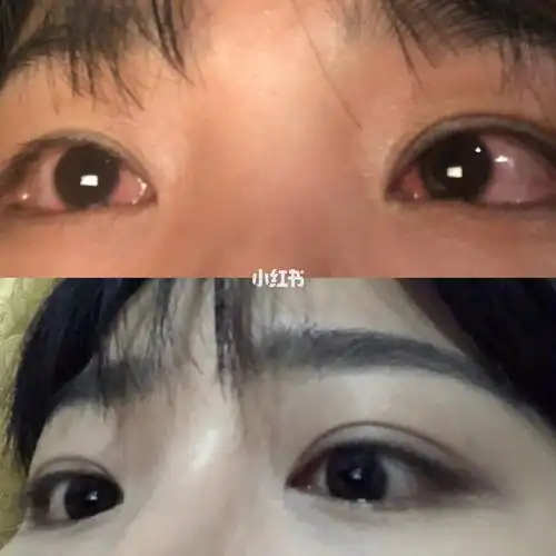 78记录一下自己这两个月对抗结膜炎的过程 (图片是时间顺序) 我是九