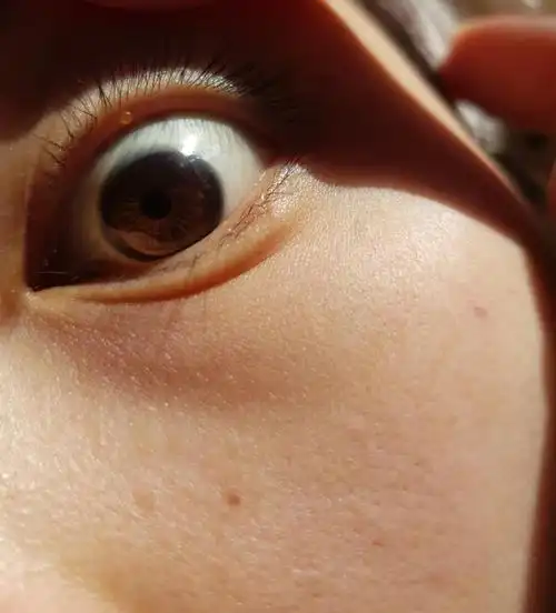 慎入眼睑的地方长了黄色的水泡有姐妹知道怎么办吗