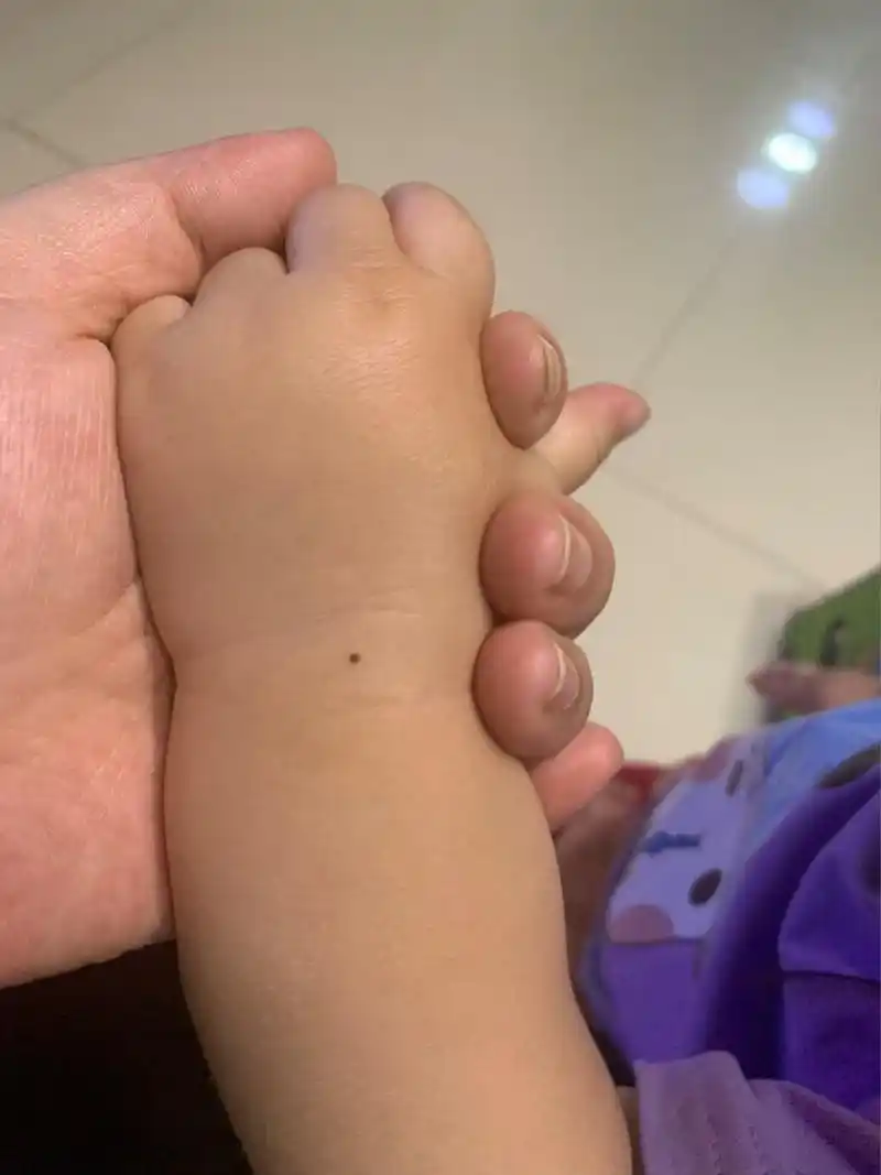 宝宝几岁开始长痣?