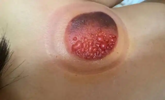 拔火罐时后背吸出的瘀血是身体排出的毒素听听医生的说法