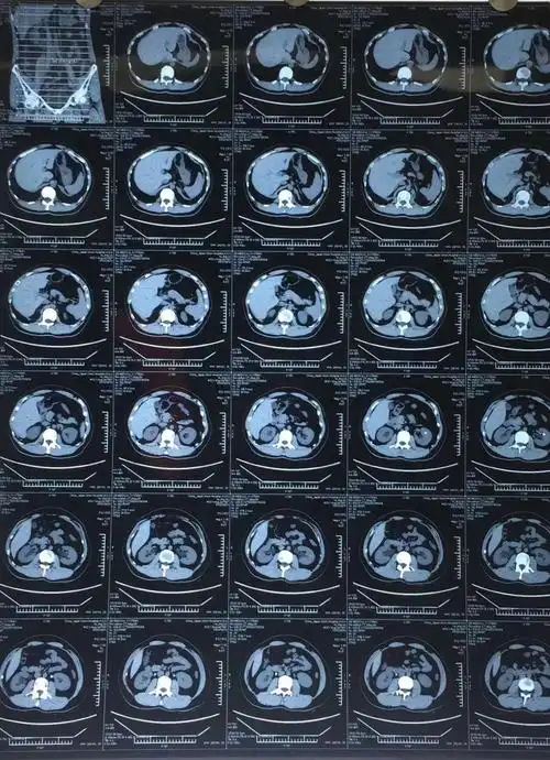 东三省双肾结石软镜一期碎石"斑马镜"首秀圆满成功