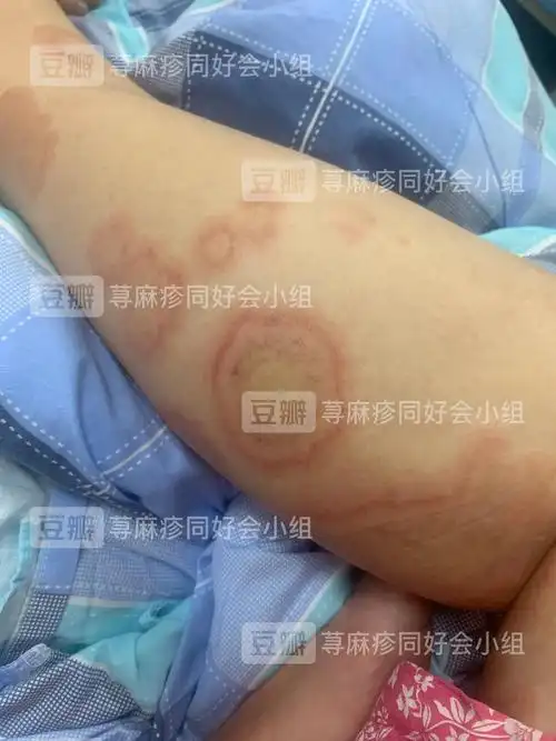 荨麻疹性血管炎!慎入