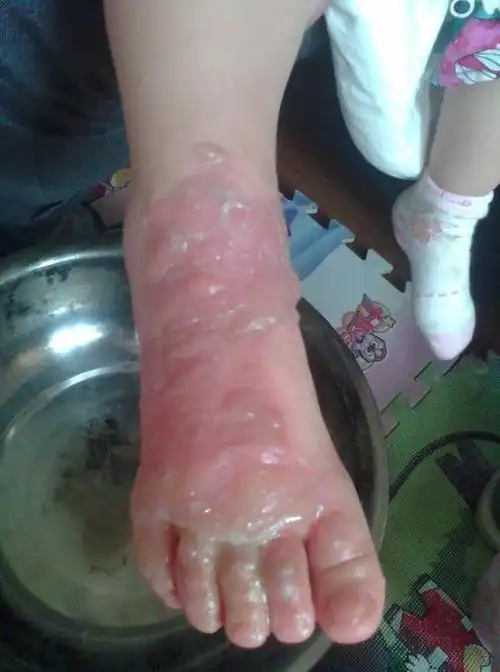 被开水烫伤怎么办快速解救方法一分钟解决