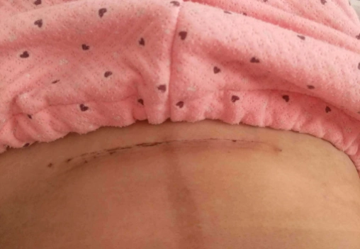 剖腹产伤口多久"愈合"?答案或许想的不一样,别错过最佳时机