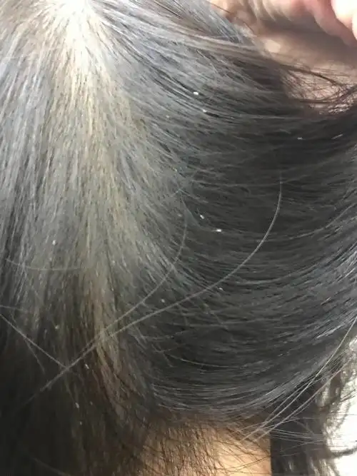 杨教授您好,我今天用酮康唑给孩子洗头以后发现头发里有这种虫子