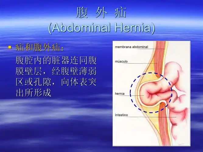 外科学课件腹股沟疝