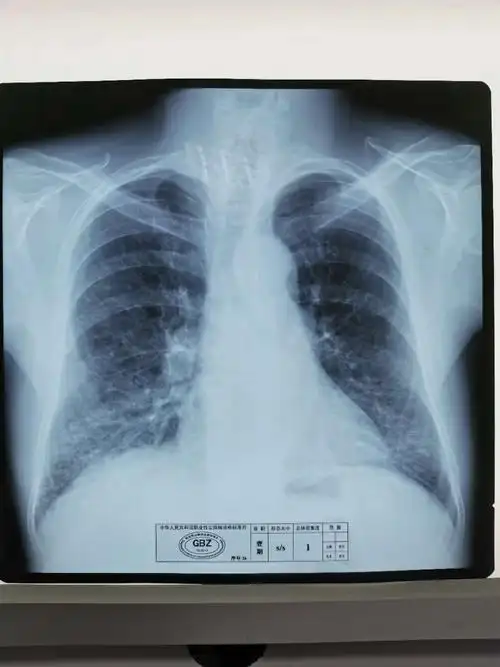 职业病尘肺标准片(照片)