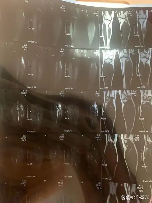 22岁发现自己右小腿患有"血管瘤伴有血栓" 是这样的症状发生的前期没