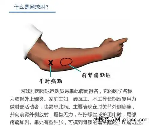 健康之路20191218张道俭什么是网球肘肘部疼痛怎么办网球肘