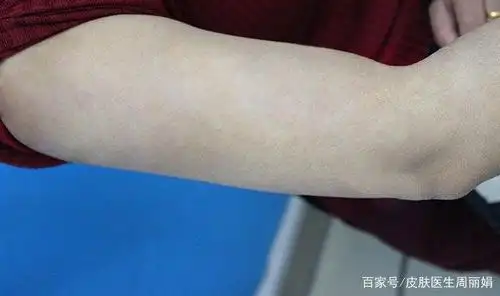 青春期出现的胎记——贝克痣