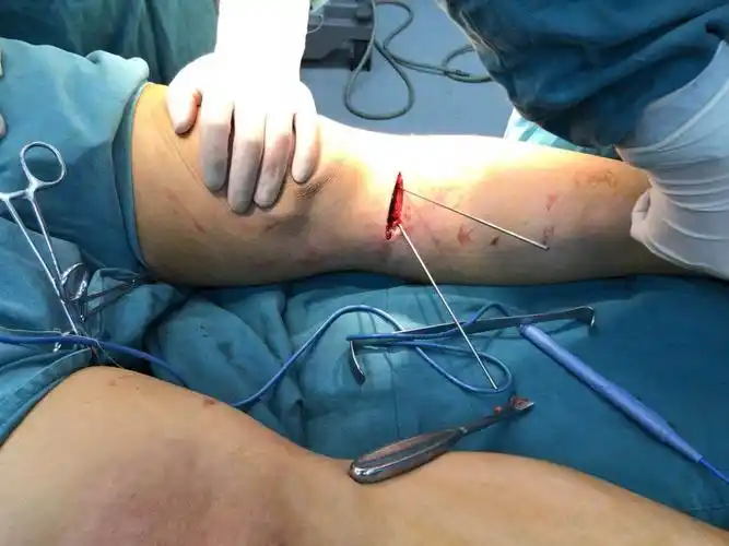 海南州首例胫骨高位截骨矫形术在贵德县人民医院成功完成