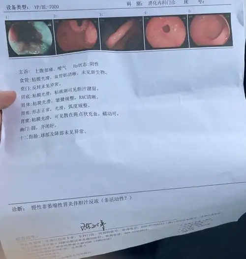 慢性非萎缩性胃炎伴胆汁反流