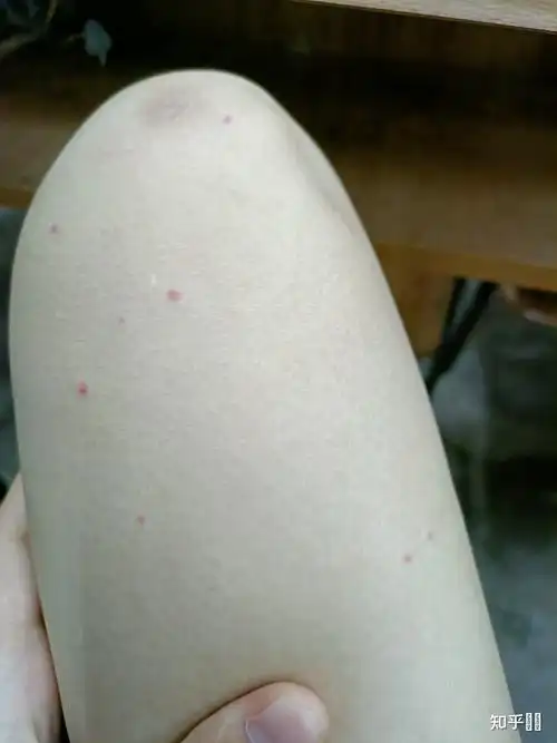 同样是被蚊子咬,为什么有些人是一个大包,有些人是一个小红点? - 知乎