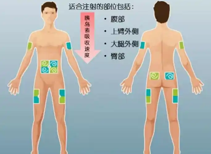 关于胰岛素注射你都做对了吗