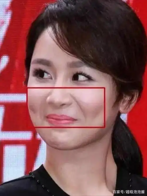 女明星也躲不过的鼻基底凹陷该怎么解决?