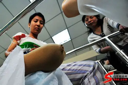 截肢女孩刘彤:蹒跚迈出人生"第二步"(图)
