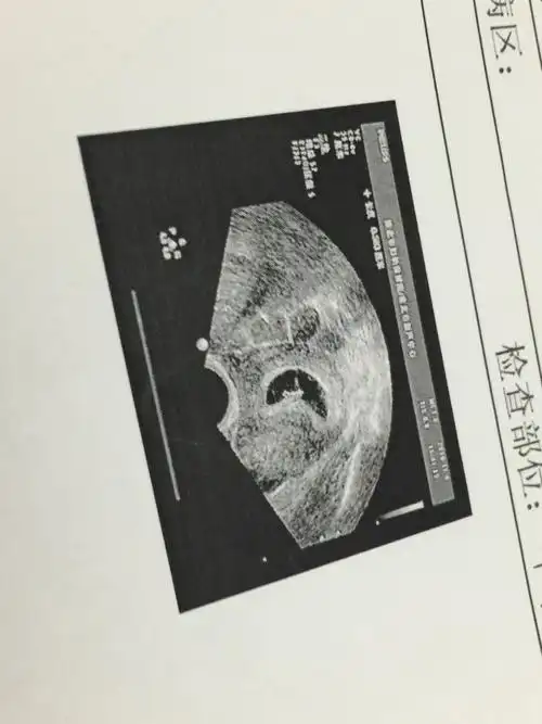 孕囊2.9*1.4看看是男宝女宝