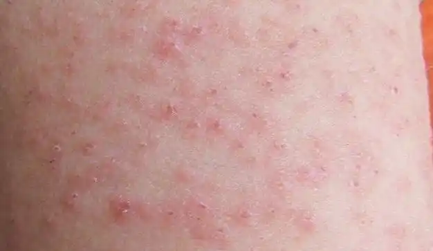 荨麻疹图片和症状荨麻疹治疗方法有哪些