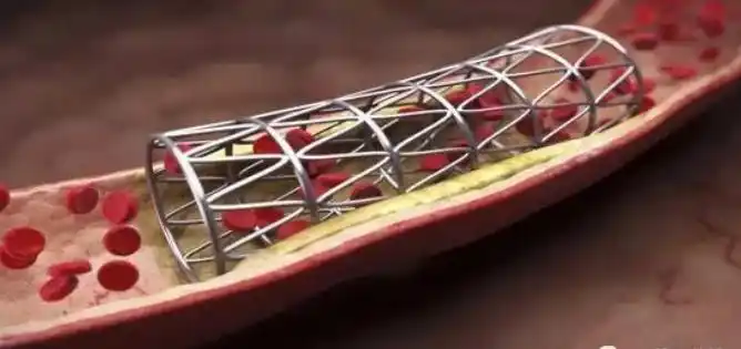 "百元"冠脉支架落地一周,疏通动脉血管,手术有风险吗?