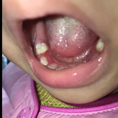 宝宝2岁,前两天发烧好了后,今天两边牙肉突然肿了,饭都不能吃,一吃就