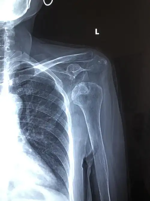 肩关节脱位请及时就医 - 好大夫在线