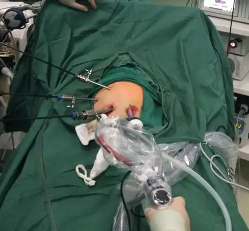 腹腔镜小儿脾切除术