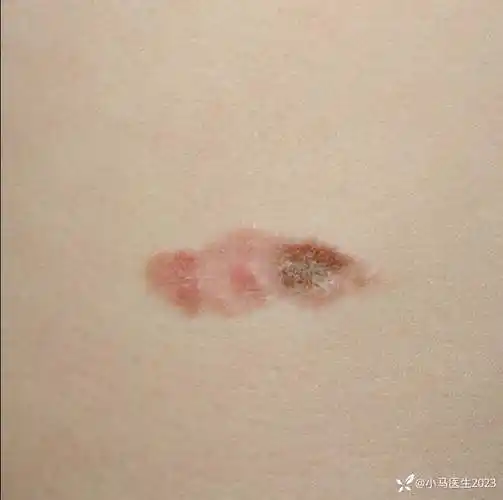 这不是湿疹也不是银屑病而是bowen病