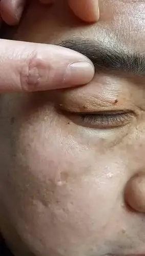 微博搜索 - 眼皮疣 - 微博