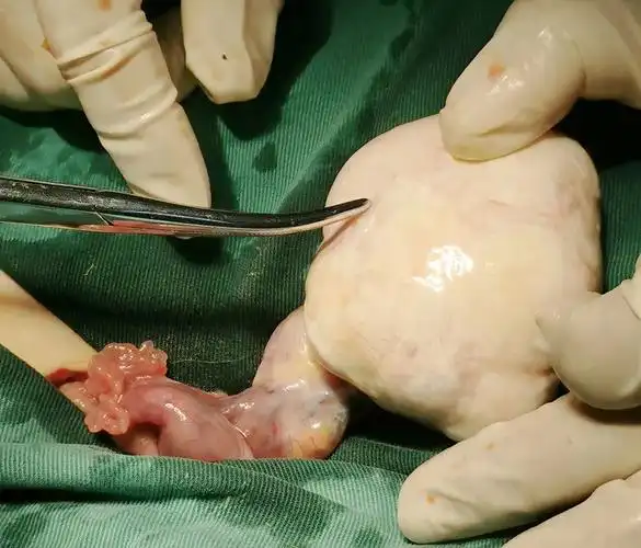 一天2位卵巢囊肿患者医生绝经期女性体检别忽视