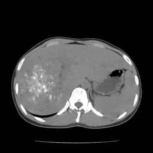 肝包虫(泡状棘球蚴)