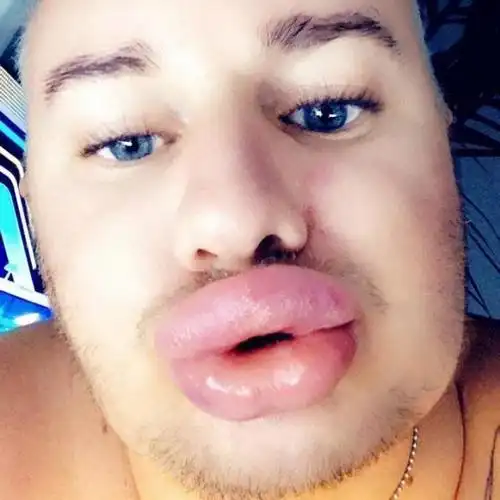 男子用6年时间整容20多次嘴唇又厚又大如同腊肠嘴