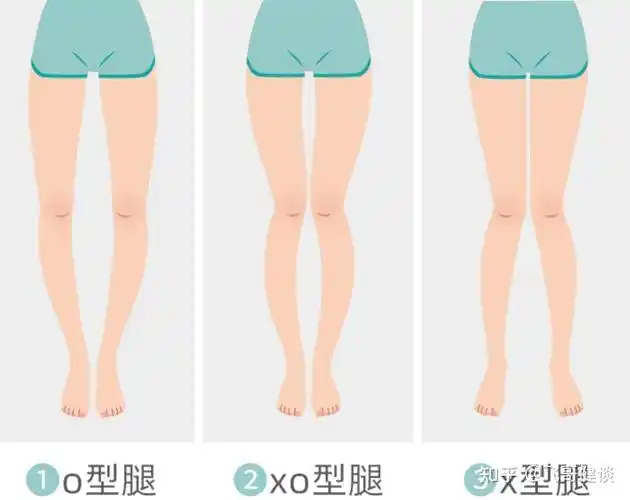哪位大佬帮我看看我这是o型腿髋外旋 还是 髋内旋? - 知乎