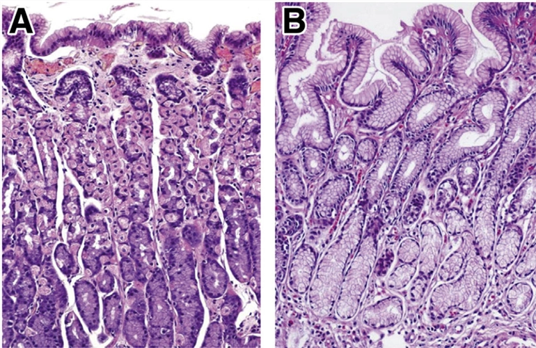 文献选读关于萎缩性胃炎的组织病理学问题