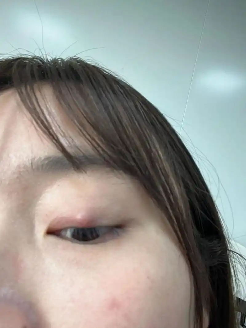 98:今年1月份左眼眼皮上开始长一个红色的小疙瘩,不痛不痒,就没怎么