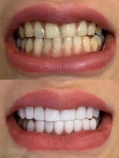 阿洛美前牙美学设计中心美牙效果对比图展示