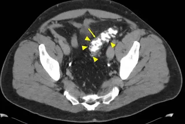 腹部ct在骨盆水平的腹部ct轴位图像:多发憩室和肠壁增厚(箭头)结肠镜